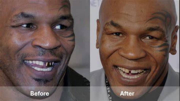 Pete Weber | What Happened | Teeth Before And After